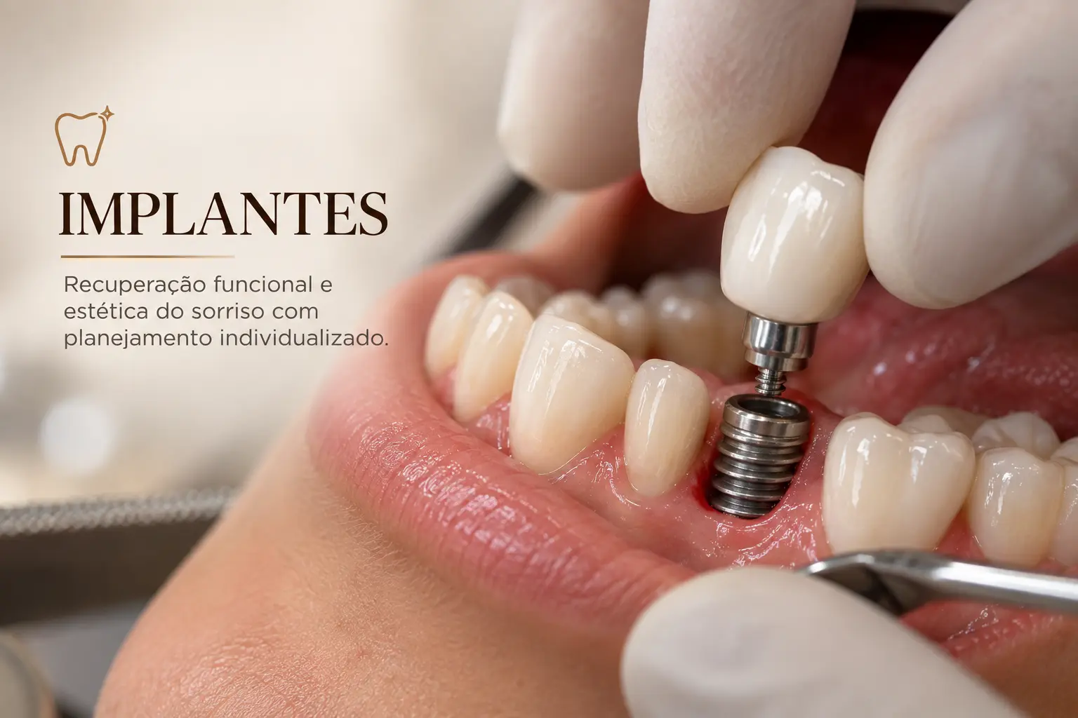 Implantes — recuperação funcional e estética do sorriso com planejamento individualizado.